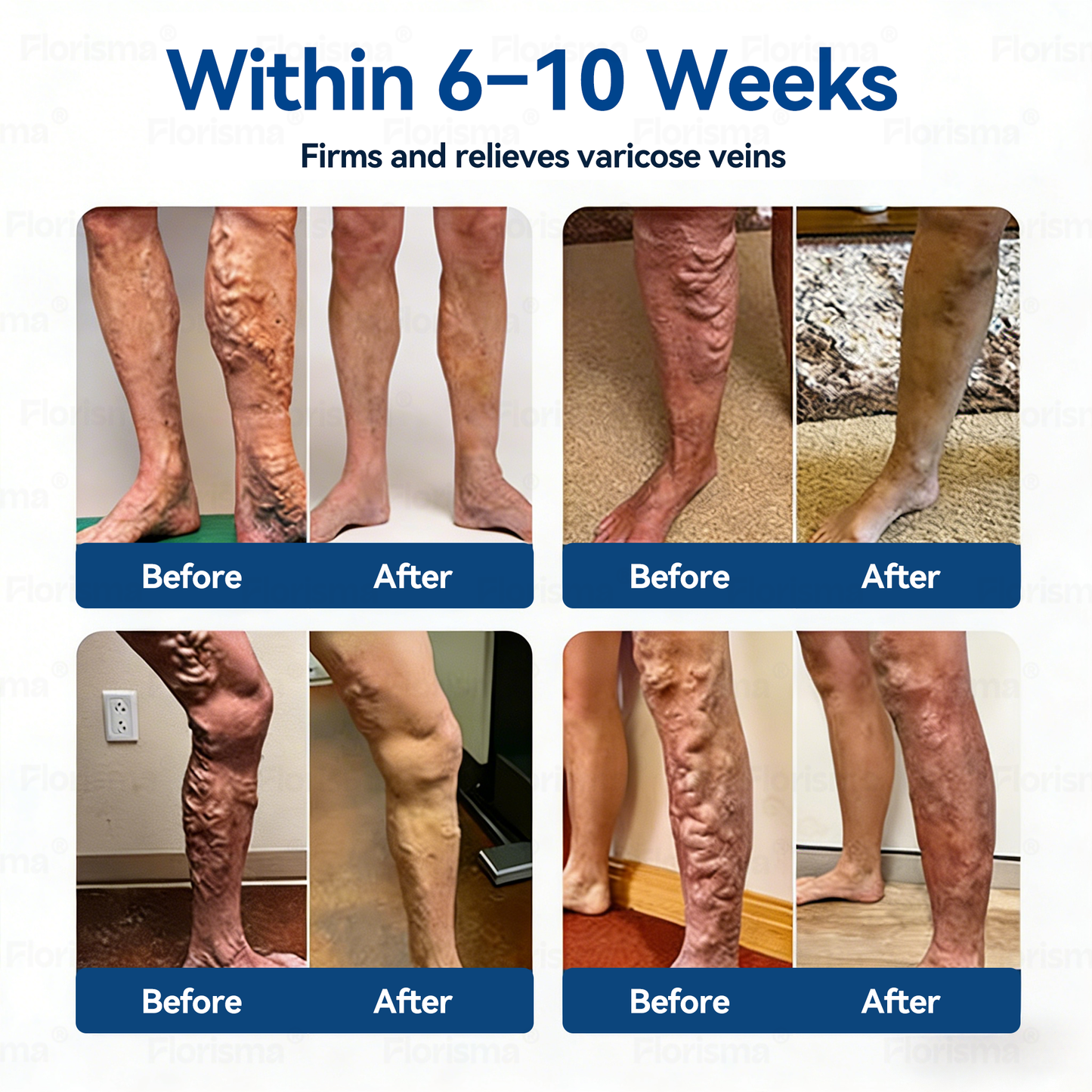 7-Day Visible Results✅𝑭𝑳𝑶𝑹𝑰𝑺𝑴𝑨® 𝐕𝐞𝐢𝐧 𝐂𝐨𝐧𝐭𝐨𝐮𝐫 𝑪𝒍𝒊𝒏𝒊𝒄𝒂𝒍-𝑮𝒓𝒂𝒅𝒆 𝑭𝒐𝒓𝒎𝒖𝒍𝒂 𝑴𝒊𝒄𝒓𝒐𝒏𝒆𝒆𝒅𝒍𝒆 𝑷𝒂𝒕𝒄𝒉(𝑫𝑰𝑶𝑺𝑴𝑰𝑵 & 𝑯𝑬𝑺𝑷𝑬𝑹𝑰𝑫𝑰𝑵)— 𝗔𝗱𝘃𝗮𝗻𝗰𝗲𝗱 𝗛𝗲𝗿𝗯𝗮𝗹 𝗕𝗹𝗲𝗻𝗱 𝗧𝗮𝗿𝗴𝗲𝘁𝘀 𝗦𝗽𝗶𝗱𝗲𝗿 𝗩𝗲𝗶𝗻𝘀 & 𝗥𝗲𝗹𝗶𝗲𝘃𝗲𝘀 𝗛𝗲𝗮𝘃𝘆, 𝗧𝗶𝗿𝗲𝗱 𝗟𝗲𝗴𝘀🍁