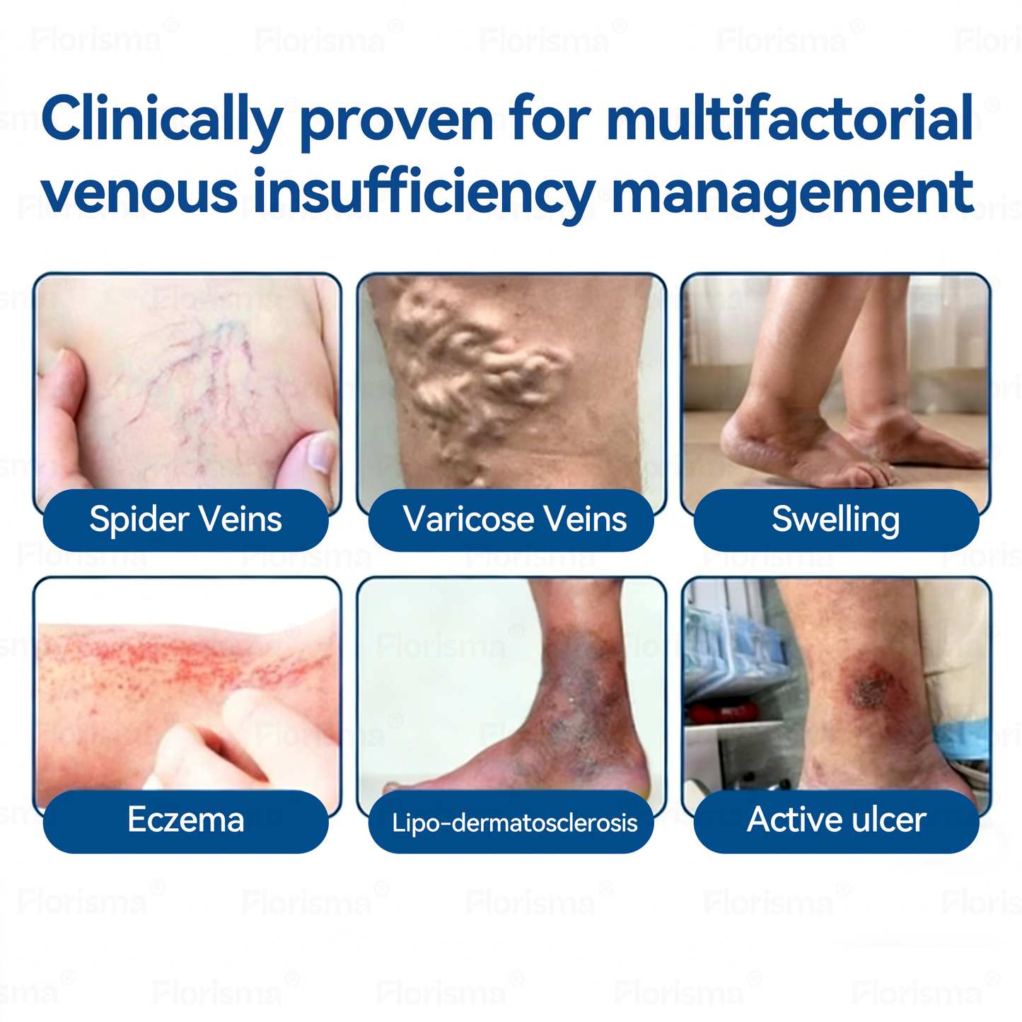 7-Day Visible Results✅𝑭𝑳𝑶𝑹𝑰𝑺𝑴𝑨® 𝐕𝐞𝐢𝐧 𝐂𝐨𝐧𝐭𝐨𝐮𝐫 𝑪𝒍𝒊𝒏𝒊𝒄𝒂𝒍-𝑮𝒓𝒂𝒅𝒆 𝑭𝒐𝒓𝒎𝒖𝒍𝒂 𝑴𝒊𝒄𝒓𝒐𝒏𝒆𝒆𝒅𝒍𝒆 𝑷𝒂𝒕𝒄𝒉(𝑫𝑰𝑶𝑺𝑴𝑰𝑵 & 𝑯𝑬𝑺𝑷𝑬𝑹𝑰𝑫𝑰𝑵)— 𝗔𝗱𝘃𝗮𝗻𝗰𝗲𝗱 𝗛𝗲𝗿𝗯𝗮𝗹 𝗕𝗹𝗲𝗻𝗱 𝗧𝗮𝗿𝗴𝗲𝘁𝘀 𝗦𝗽𝗶𝗱𝗲𝗿 𝗩𝗲𝗶𝗻𝘀 & 𝗥𝗲𝗹𝗶𝗲𝘃𝗲𝘀 𝗛𝗲𝗮𝘃𝘆, 𝗧𝗶𝗿𝗲𝗱 𝗟𝗲𝗴𝘀🍁