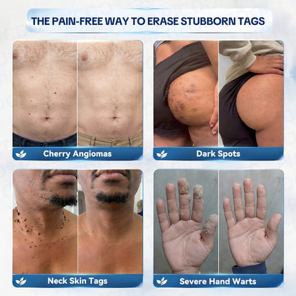 𝐏𝐢𝐜𝐝𝐨® 7-𝐃𝐚𝐲 𝐒𝐤𝐢𝐧 𝐓𝐚𝐠 & 𝐒𝐩𝐨𝐭 𝐄𝐫𝐚𝐬𝐞𝐫 𝐂𝐫𝐞𝐚𝐦🩵(Zero Pain, Zero 𝐒𝐜𝐚𝐫𝐬 Formula)🚀