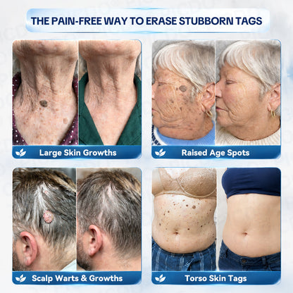 𝐏𝐢𝐜𝐝𝐨® 7-𝐃𝐚𝐲 𝐒𝐤𝐢𝐧 𝐓𝐚𝐠 & 𝐒𝐩𝐨𝐭 𝐄𝐫𝐚𝐬𝐞𝐫 𝐂𝐫𝐞𝐚𝐦🩵(Zero Pain, Zero 𝐒𝐜𝐚𝐫𝐬 Formula)🚀