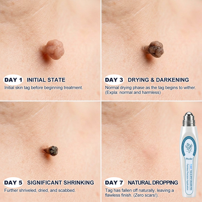 𝐎𝐟𝐟𝐢𝐜𝐢𝐚𝐥 𝐁𝐫𝐚𝐧𝐝 𝐒𝐭𝐨𝐫𝐞 |✅𝐏i𝐜𝐝o® 7-𝐷𝑎𝑦 𝗧𝐚𝐠 & 𝗦𝗽𝐨𝐭 𝐄𝐫𝒂𝒔𝒆𝒓(Zero Pain, Zero 𝐒𝐜𝐚𝒓𝒔 Rollerball)🍁